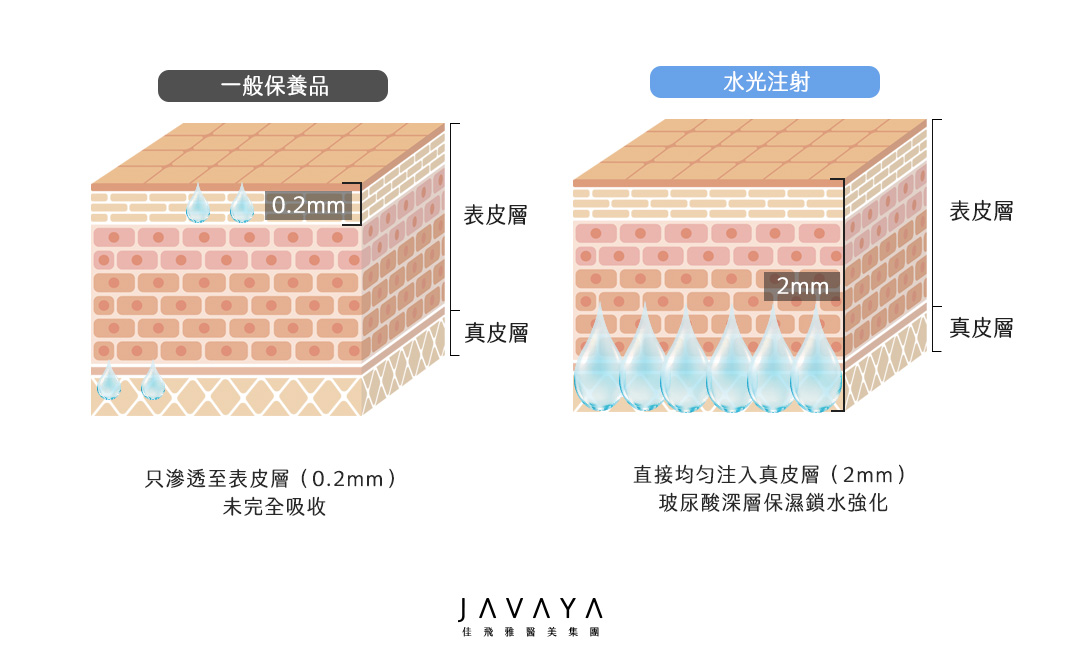 水光注射/水光槍 一般保養品(只滲透至表皮的角質層、未完全吸收)VS水光槍(直接注至真皮層,保濕所水強化) | 佳飛雅醫美